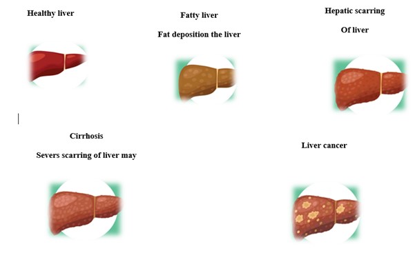 summarizes current theories about the etiology of both acute and chronic liver failure in relation to alcohol-related liver disease