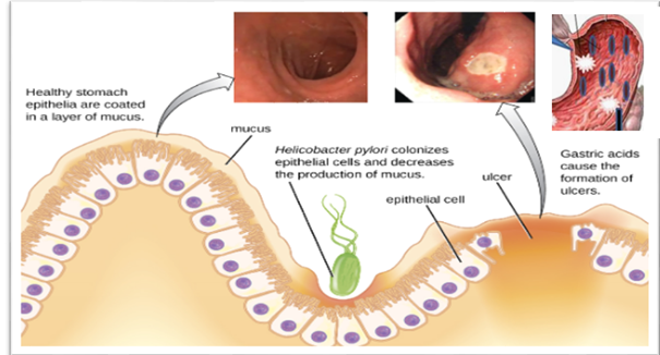 Pathogenesis of peptic ulcer